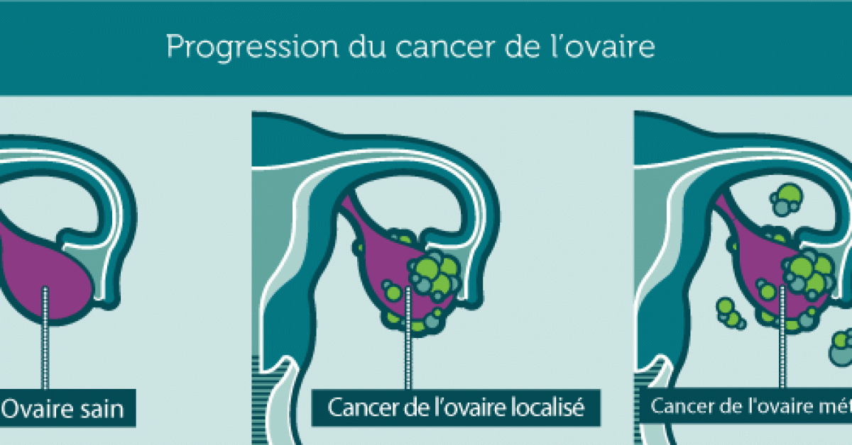 10 signes du cancer des ovaires qui risque de vous tuer silencieusement 1