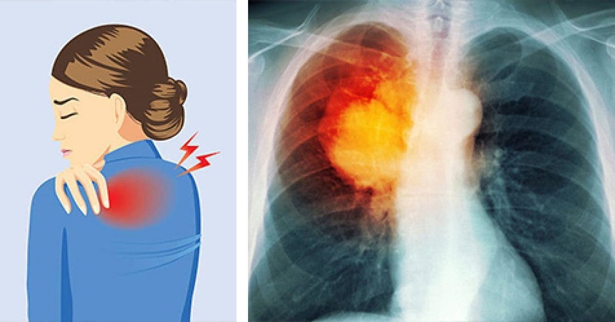 10 signes du cancer du poumon