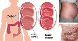 10 signes precurseurs dun cancer du colon 1