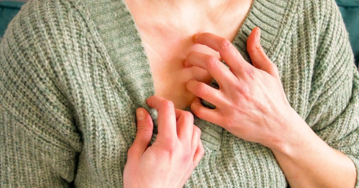Comment traiter la dermatite atopique et soulager la peau ?