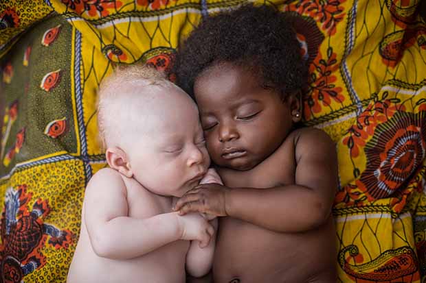 Un nouveau-né albinos de 3 semaines dormant tranquillement avec son cousin à Kinshasa