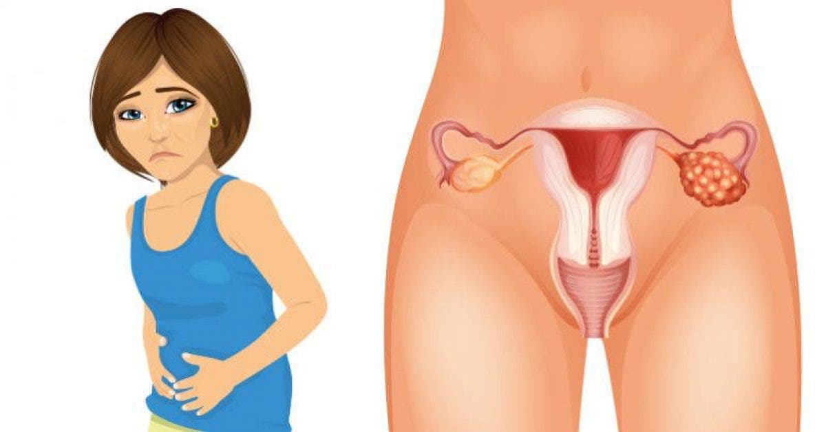 4 Symptômes précoces du cancer de l'ovaire que chaque femme doit absolument connaitre