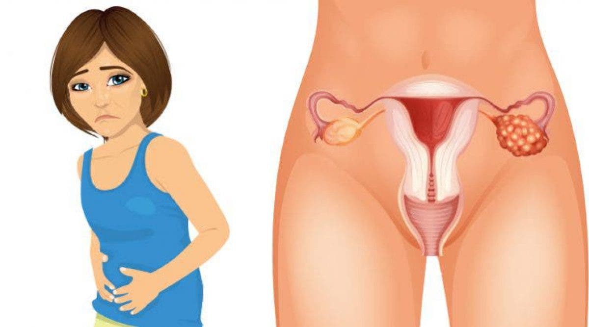4 Symptômes précoces du cancer de l'ovaire que chaque femme doit absolument connaitre