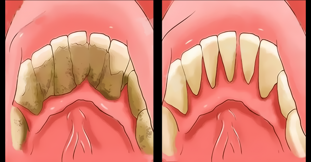 4-manieres-deliminer-le-tartre-des-dents-naturellement