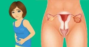 4 signes précoces du cancer ovarien qu’il ne faut plus ignorer !
