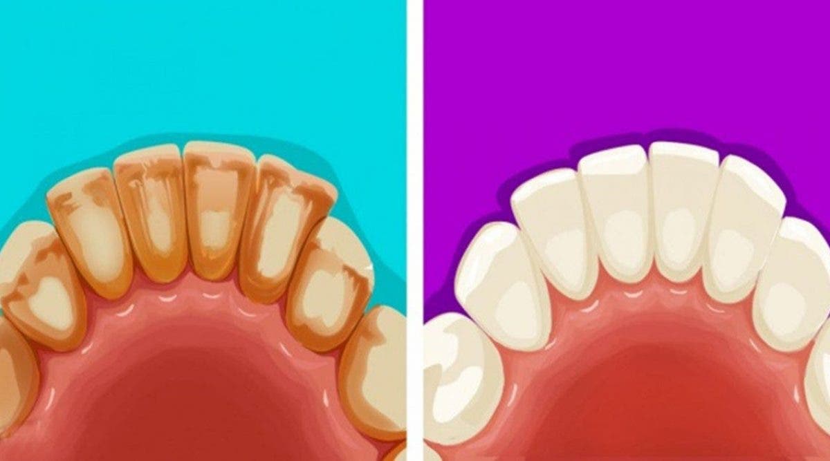 astuces naturelles pour éliminer la plaque dentaire et blanchir les dents