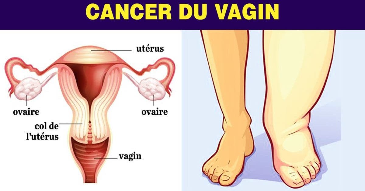 5 symptomes du cancer du vagin 1