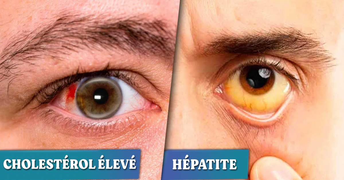 6-maladies-que-vos-yeux-peuvent-reveler