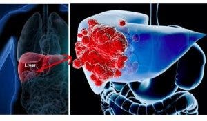 6 signes que le cancer du foie risque de se développer dans votre corps