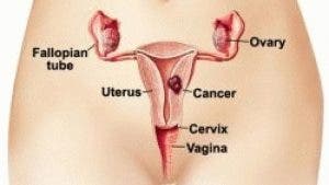 7 signes du cancer du col de l’utérus que les femmes doivent vérifier