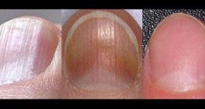 8 problemes de sante detectable sur vos ongles 1