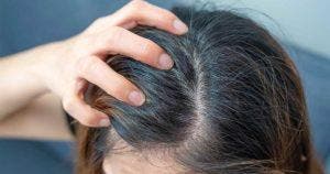 8 remèdes naturels contre la chute de cheveux