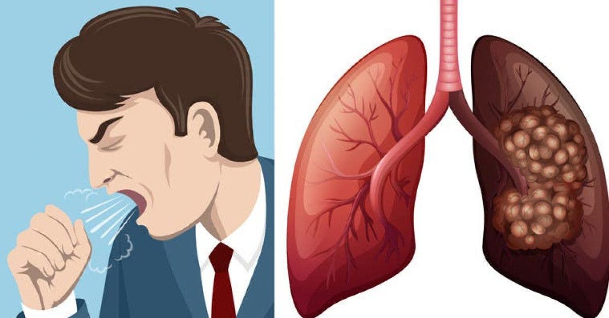 8 signes du cancer du poumon que vous devez connaitre 1