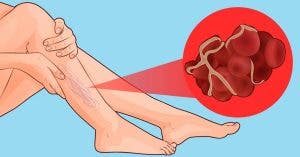 8 signes que vous avez un caillot sanguin qui peut provoquer un infarctus ou un AVC