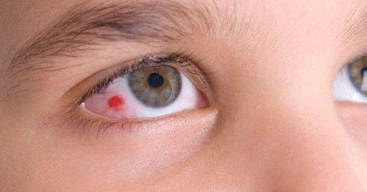 9 signes que vous avez un probleme aux yeux 1