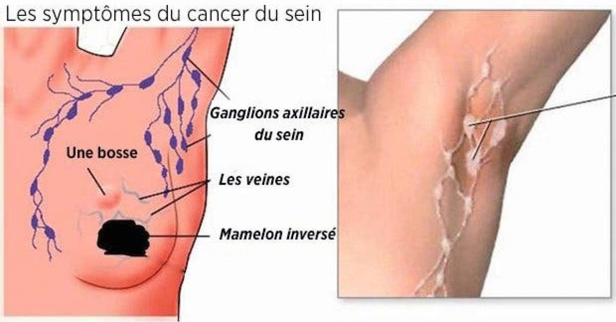 cancers du sein