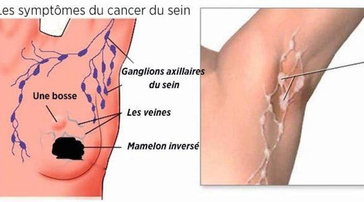 cancers du sein