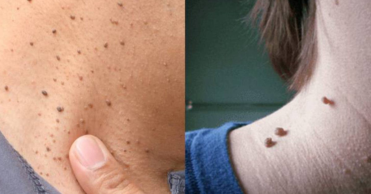 Acrochordons : que signifient ces excroissances sur la peau ?