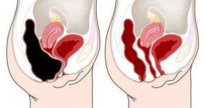Appuyer sur ce point de votre ventre pour éliminer les toxines du colon