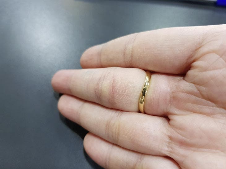 Anillo pegado en el dedo