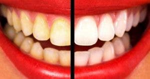 Blanchissez vos dents jaunes en moins de 2 minutes