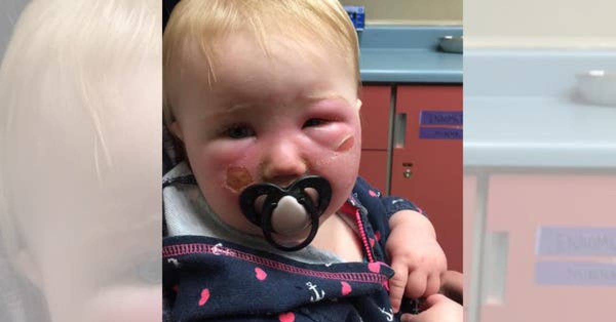 Ce bébé a eu des brûlures sévères – maintenant sa mère prévient contre ce produit !