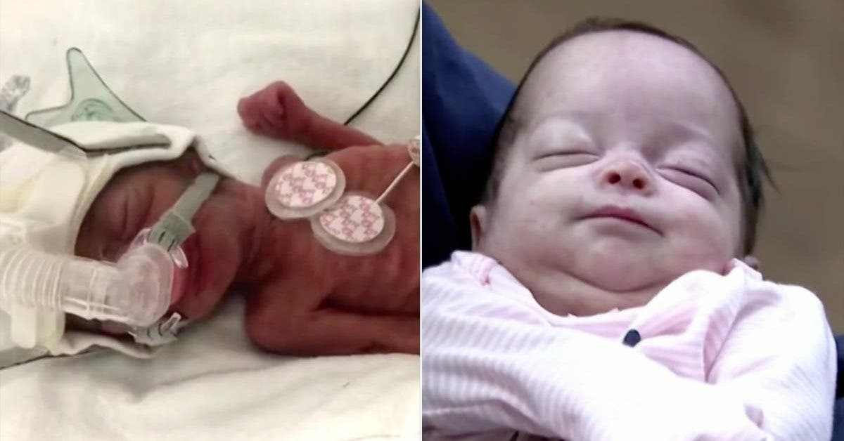 Ce bebe miracle qui pese 450 grammes survit et rentre a la maison