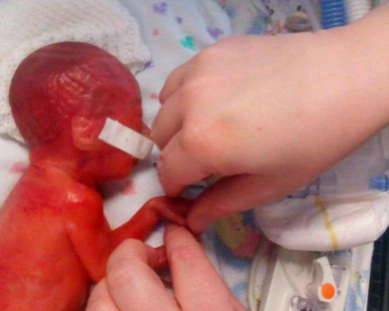 Ce bébé né prématuré se bat pour survivre et défie la mort