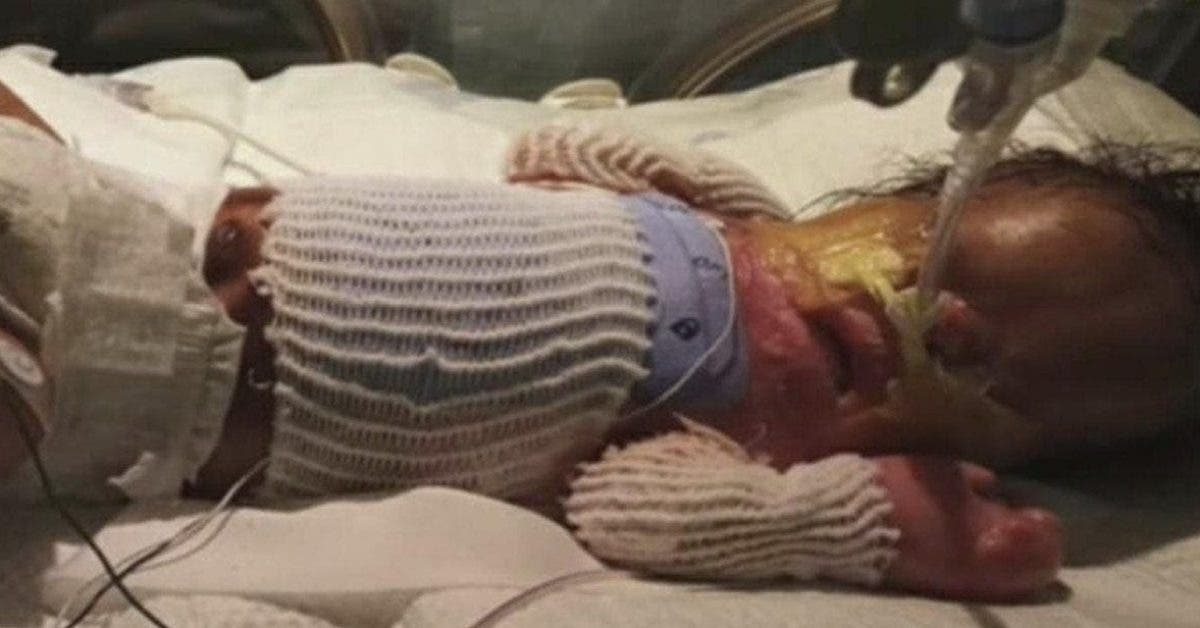 Ce bébé né sans peau se prépare pour une importante opération chirurgicale