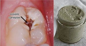 Ce dentifrice maison lutte contre les problemes dentaires les maladies gingivales et blanchit les dents naturellement 1