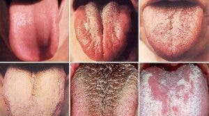 Cette couleur de langue peut révéler un cancer. Faites attention !