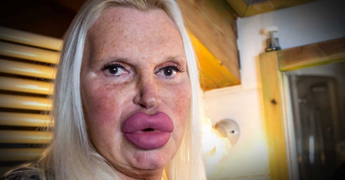 Cette femme a dépensé 46 000 euros en chirurgie pour avoir un visage parfait