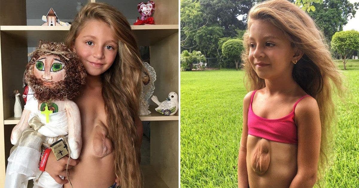 Cette fillette de 8 ans nee avec le coeur en dehors de sa poitrine espere une operation chirurgicale 1