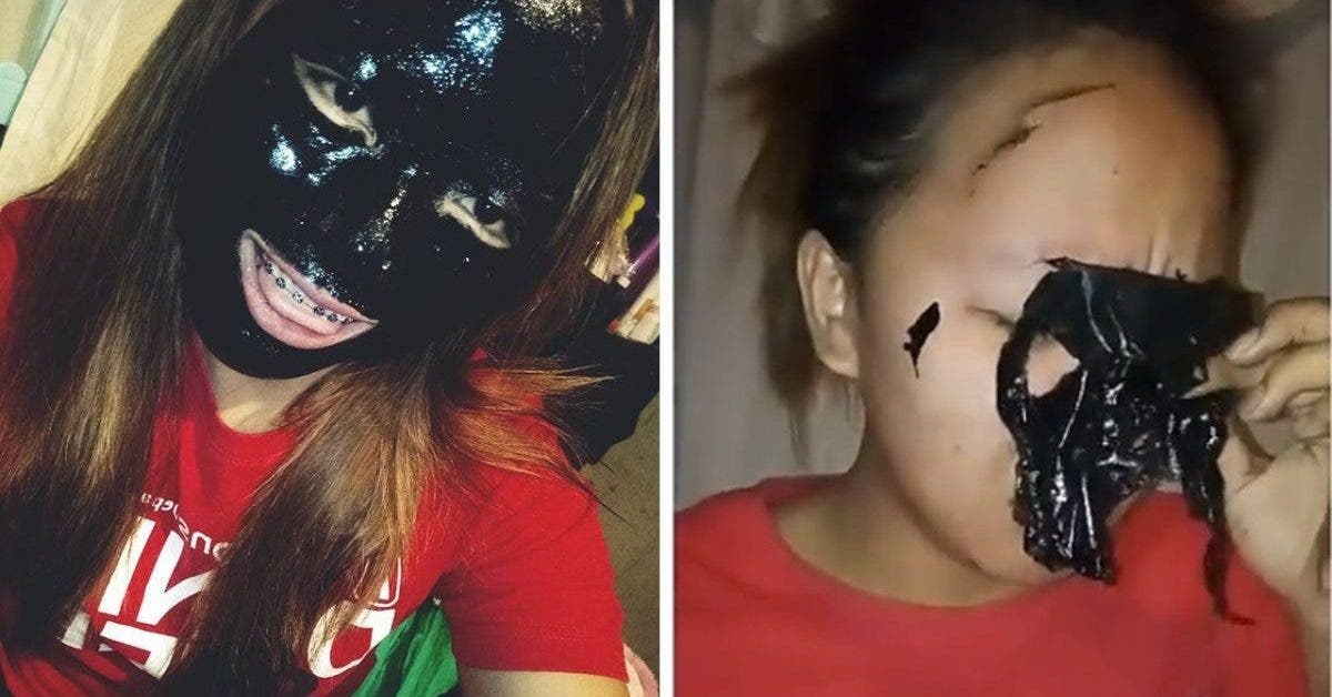 Cette jeune fille a perdu ses sourcils quand elle a utilise le celebre masque anti points noirs 1 1