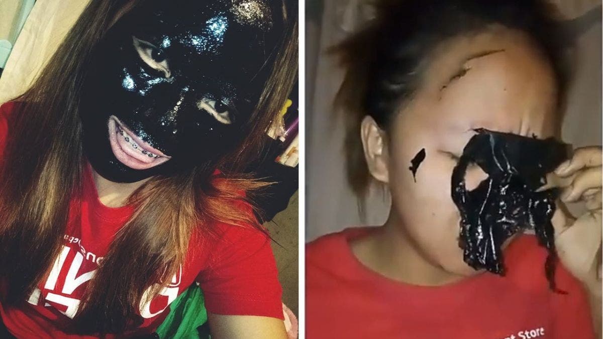 Cette jeune fille a perdu ses sourcils quand elle a utilise le celebre masque anti points noirs 1 1