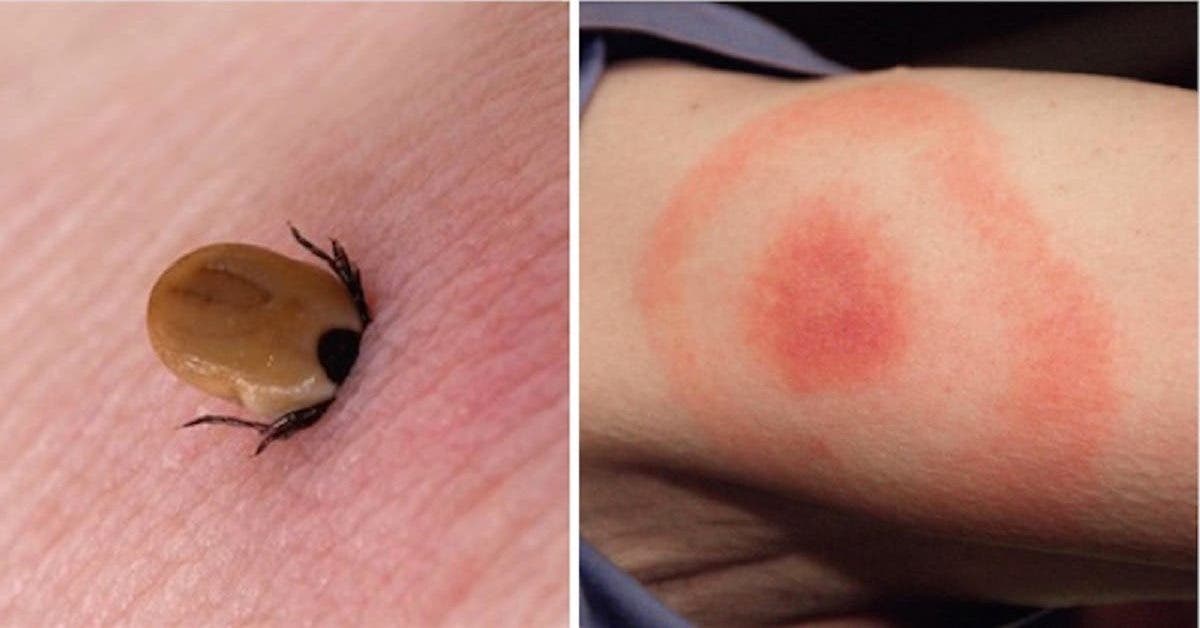 Amateurs de nature, attention aux morsures de tiques, elles peuvent causer une infection appelée la maladie de Lyme ! Mais pas de panique, voici des conseils utiles pour la prévenir.