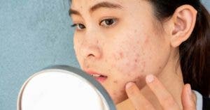 Comment traiter une peau à tendance acnéique