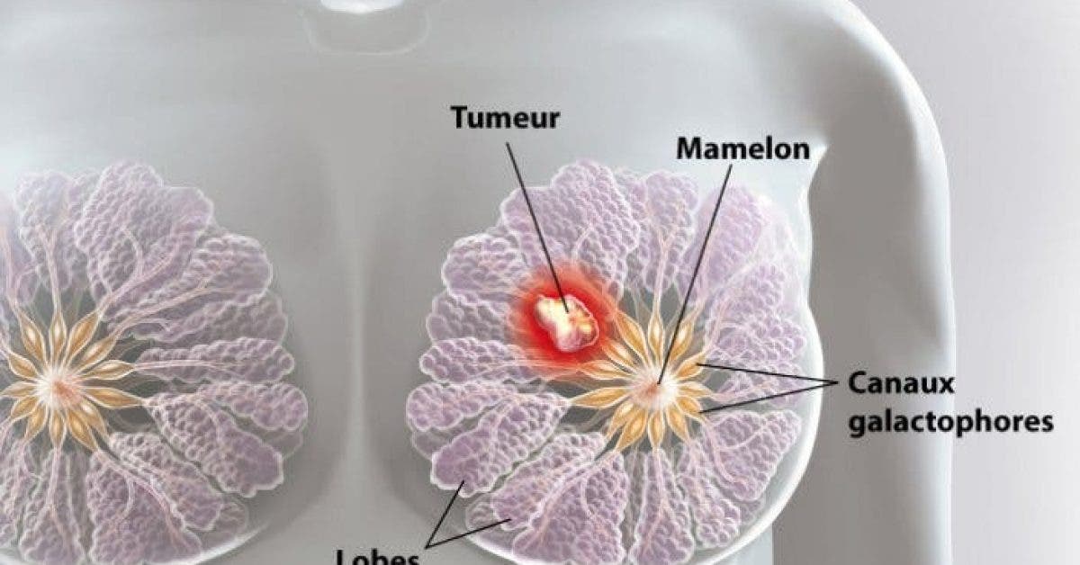 Des scientifiques ont détruit des cellules du cancer du sein en 11 jours