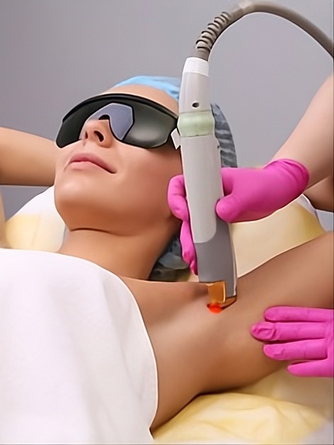 Epilation définitive du visage au laser.