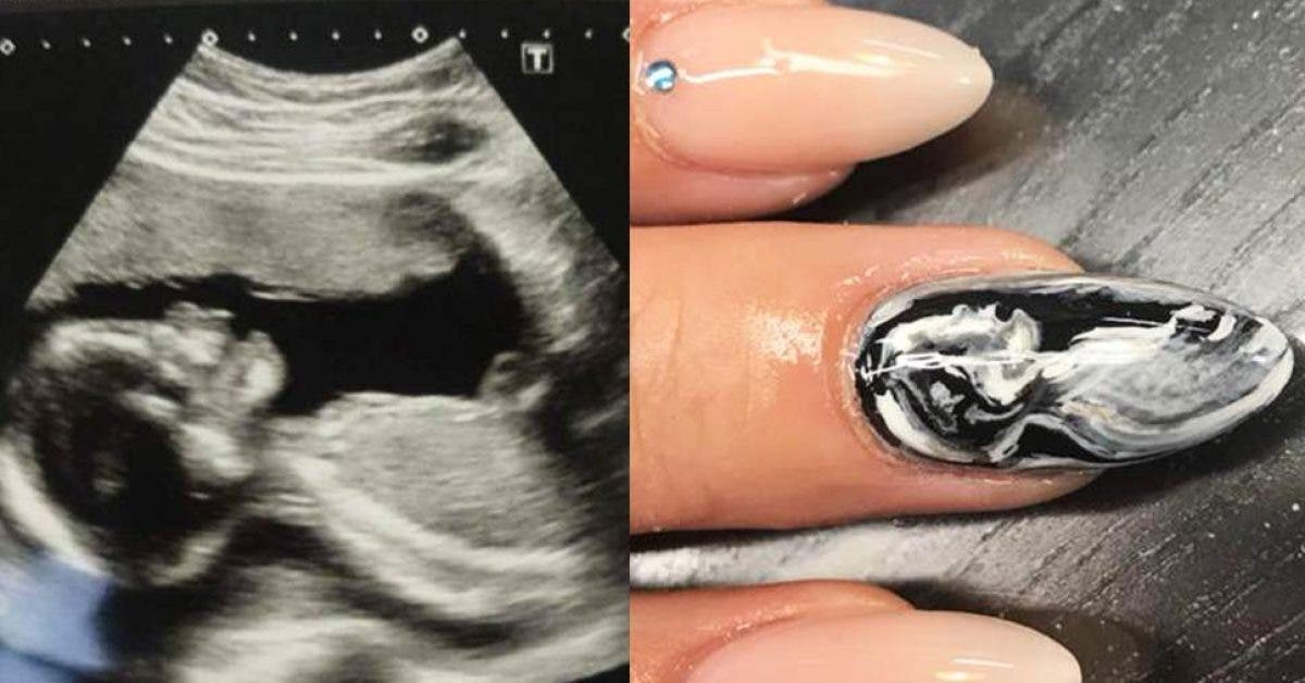La nouvelle mode pour les femmes enceintes est de se faire vernir son échographie sur les ongles