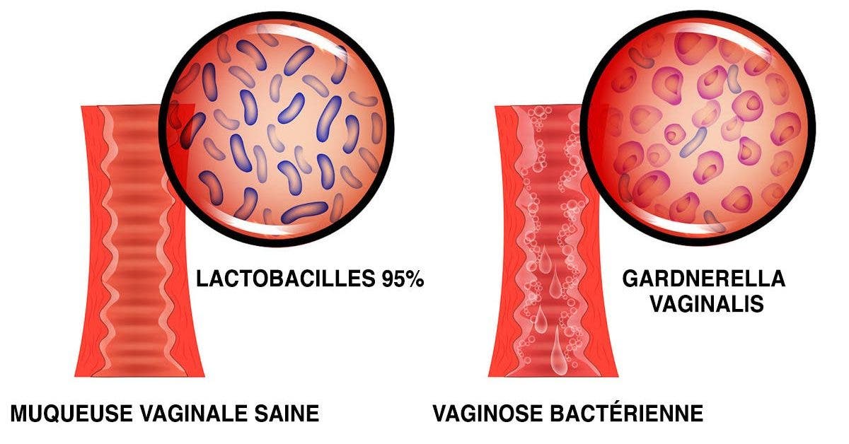 La viginose bactérienne cause des brûlures, des démangeaisons et des pertes malodorantes : voici comment vous en débarasser