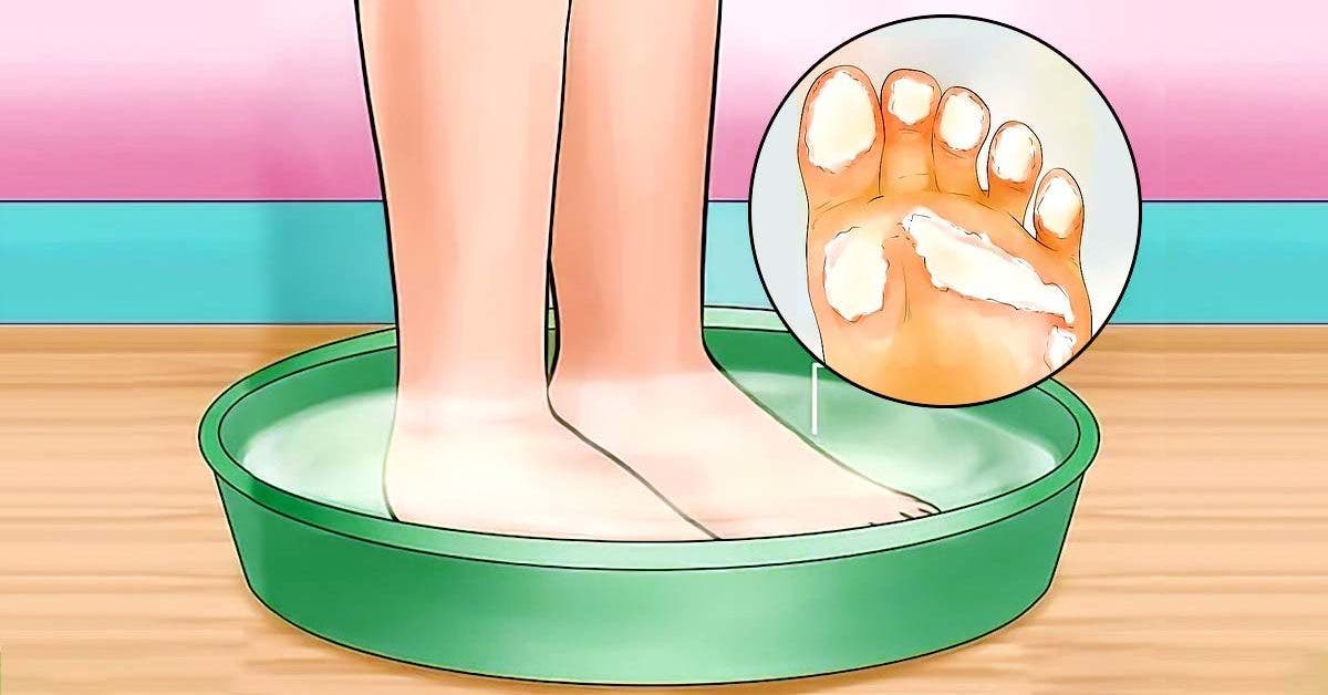 L'astuce magique pour avoir des pieds doux sans corne, ni talons fendillés