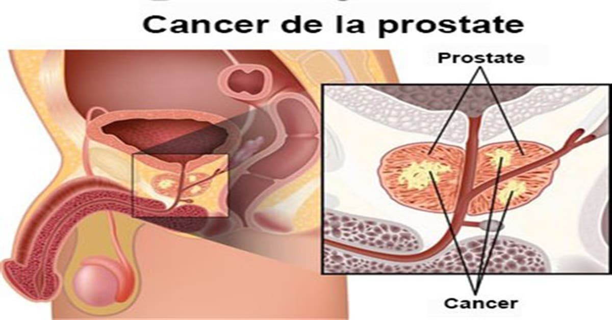 cancer de prostate