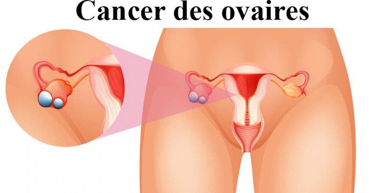 Cancer des ovaires