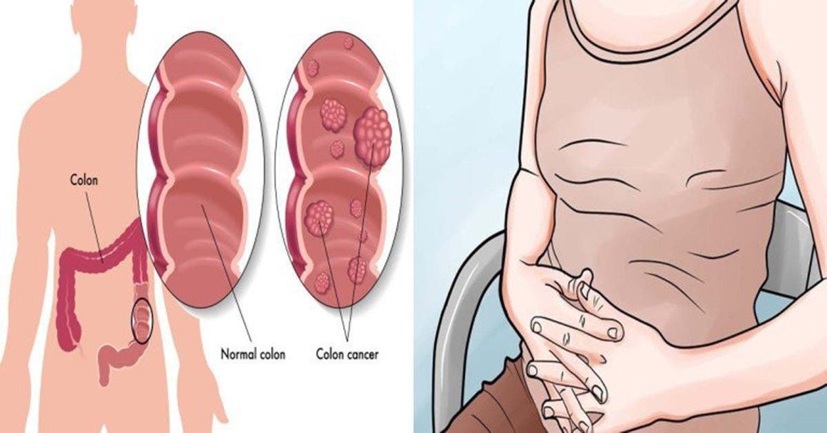 Le cancer du colon est un tueur silencieux : 5 signe à repérer