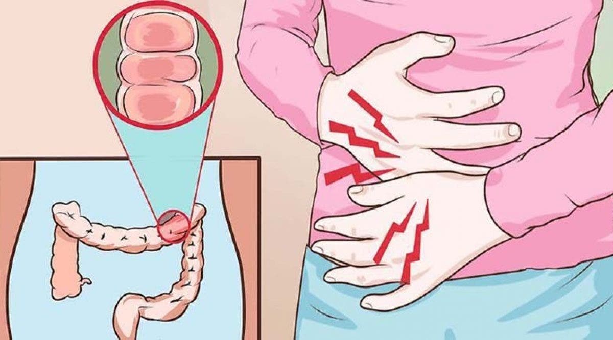 Le cancer du colon est un tueur silencieux : 4 symptômes à détecter