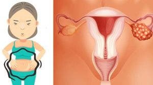 Les 10 signes du cancer des ovaires que chaque femme doit connaitre 1
