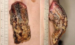 Les médecins découvrent une corne de 14 centimètres sur le dos d'un homme
