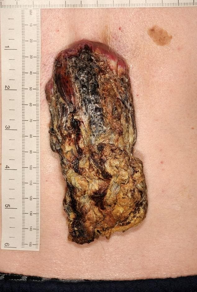 Les médecins découvrent une corne de 14 centimètres sur le dos d'un homme