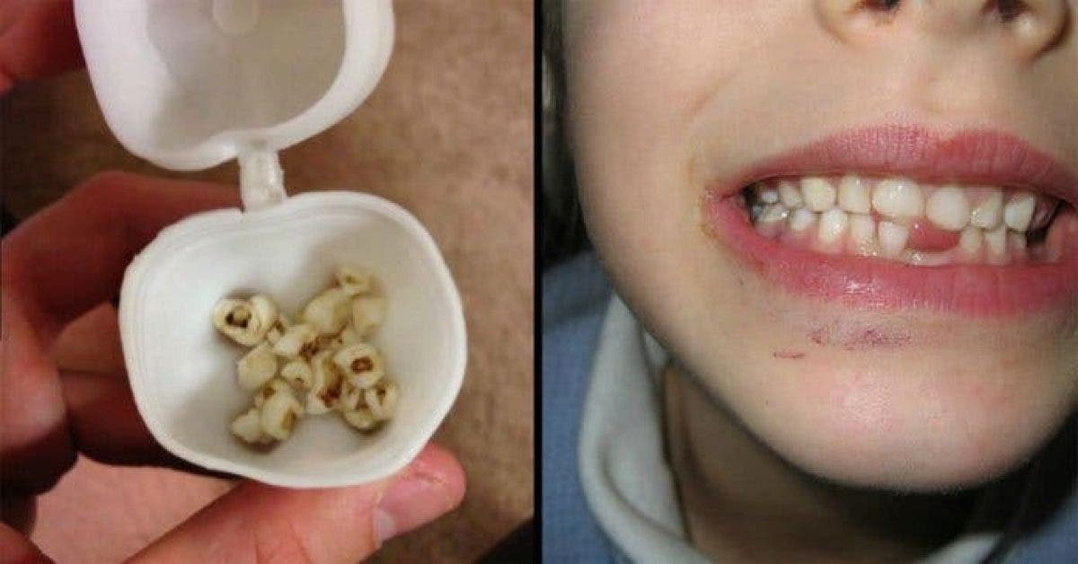 Les médecins demandent aux parents de ne pas jeter les dents de lait des enfants